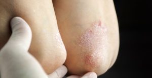 plaque psoriasis on an elbow