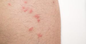 bed bug bites on human skin