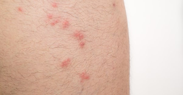 bed bug bites on human skin