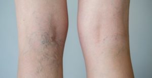 spider veins on legs